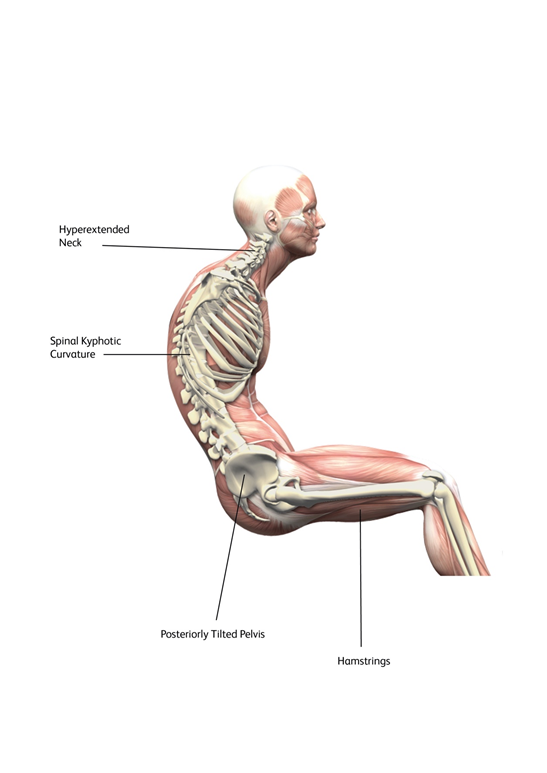 Figure demonstrating the consequences of foot position on those with shortened hamstring